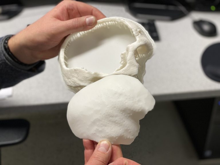 Dem zehnjährigen Bub wurde mit einem 3D-Drucker ein neues Knochenstück nachgebaut <span class="copyright">APA/Wolfgang Fürweger</span>