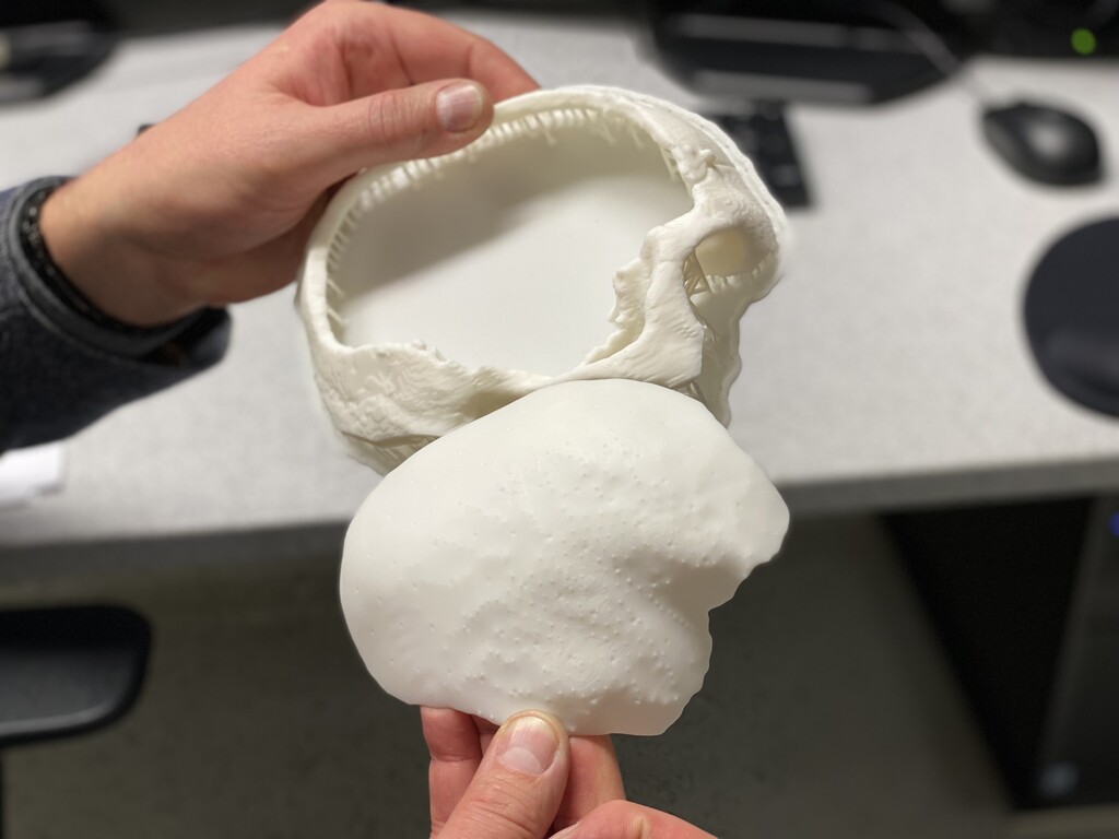 Junge aus Bayern erhielt Schädeldecke aus 3D-Drucker