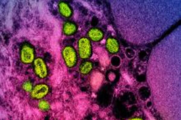 Schweden meldet ersten Mpox-Fall außerhalb Afrikas