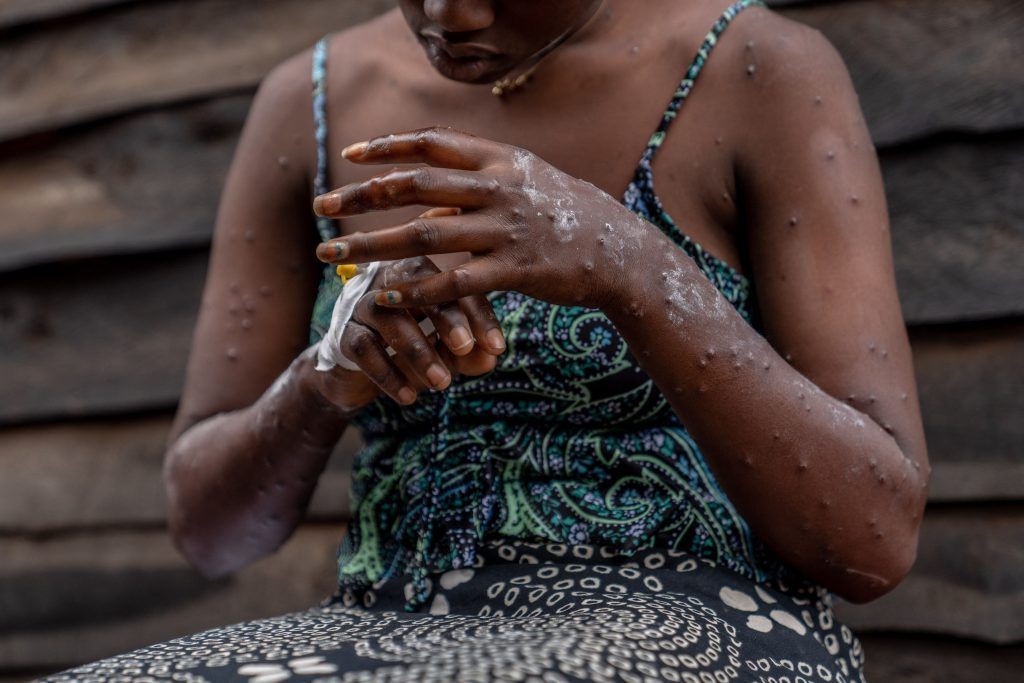 Mpox in Afrika laut Behörden außer Kontrolle
