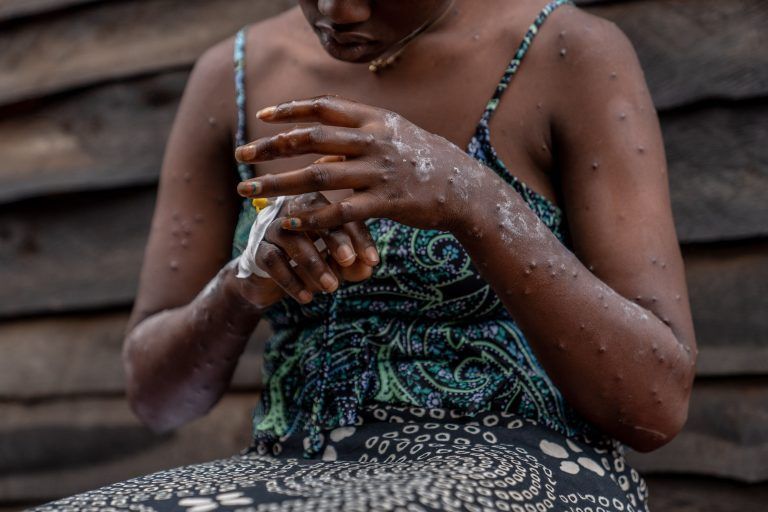 FILES-DRCONGO-HEALTH-VIRUS-MPOX-VACCINE