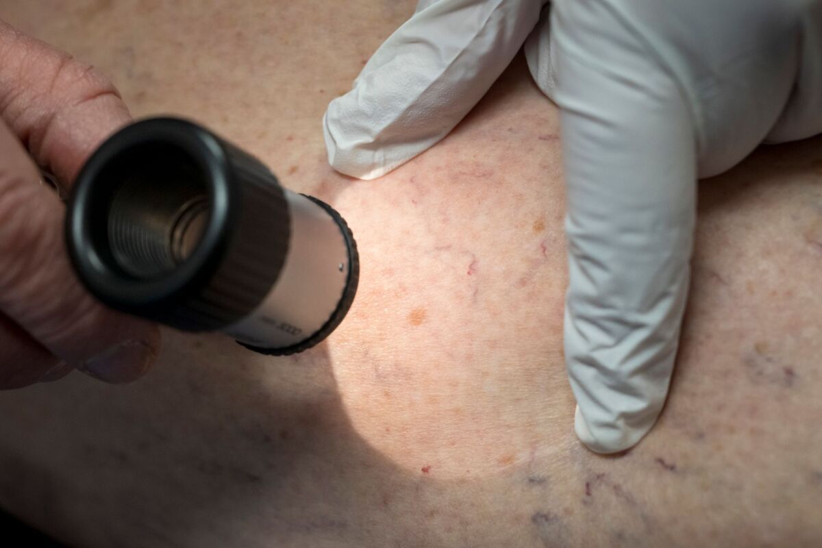 Dermatologen für risikobasierte Hautkrebs-Vorsorge