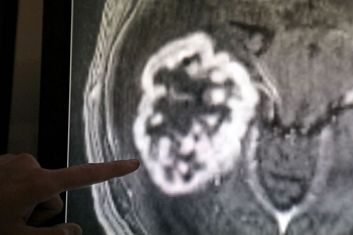 WHO fürchtet Verdoppelung der Krebsdiagnosen
